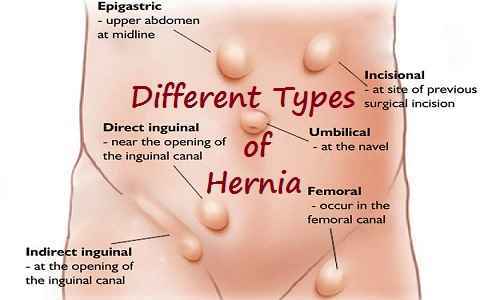 how can you die from a hernia
