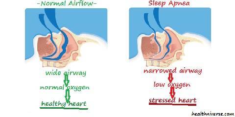 kinds of sleep apnea
