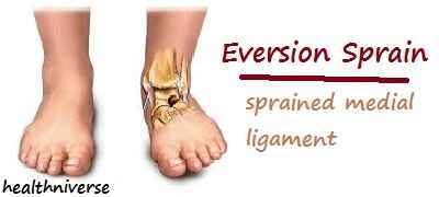 inversion and eversion lateral ankle sprain
