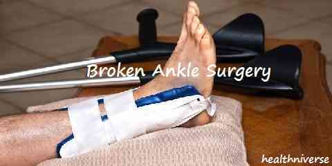 broken ankle surgery