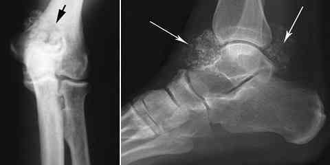 broken ankle torn ligament tendon surgery plate screws