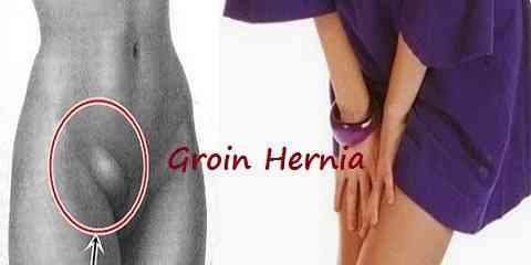 hernia in groin area versus pulled muscle groin female male