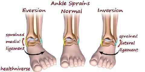 how to tell if ankle is broken or sprained