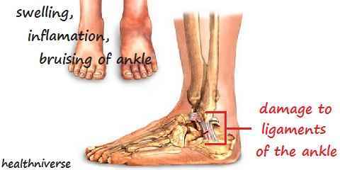 rolled twisted ankle symptoms