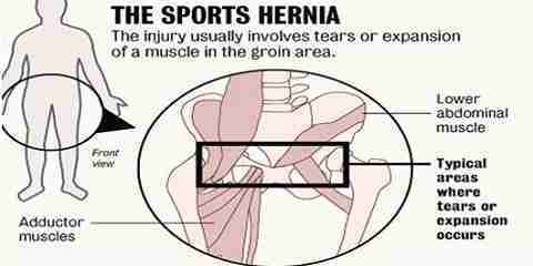 sports hernia symptoms in men male female how does it look like