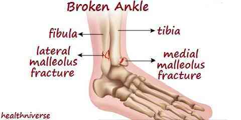 sprained or broken ankle