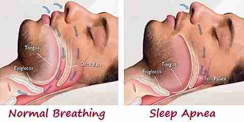 surgery to stop sleep apnea and snoring