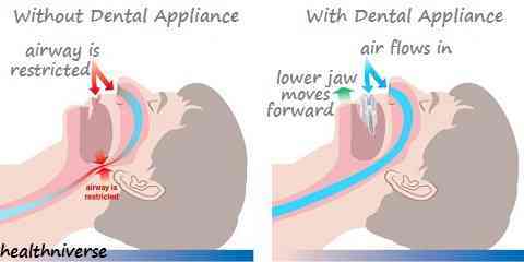 dental device for sleep apnea dental appliance for snoring